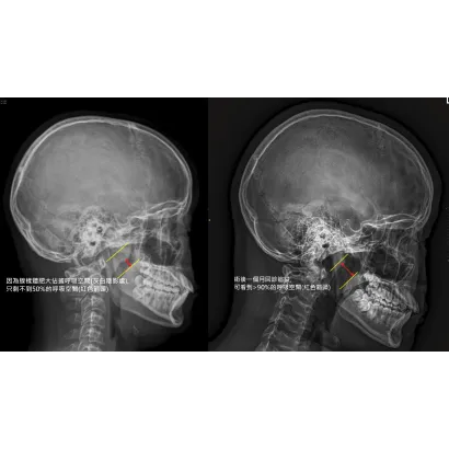 孩子睡覺打呼很大聲，真的是因為「睡得香」嗎？