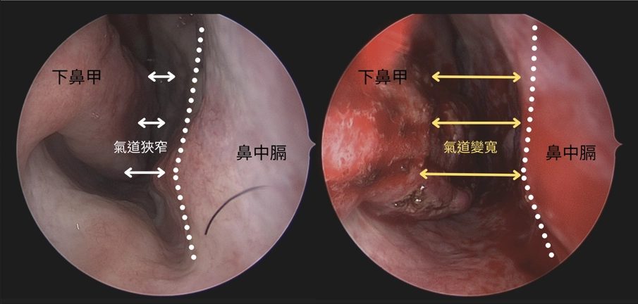 雙北鼻部微創手術案例：下鼻甲無線射頻減積與外移前後氣道寬敞度內視鏡對比圖