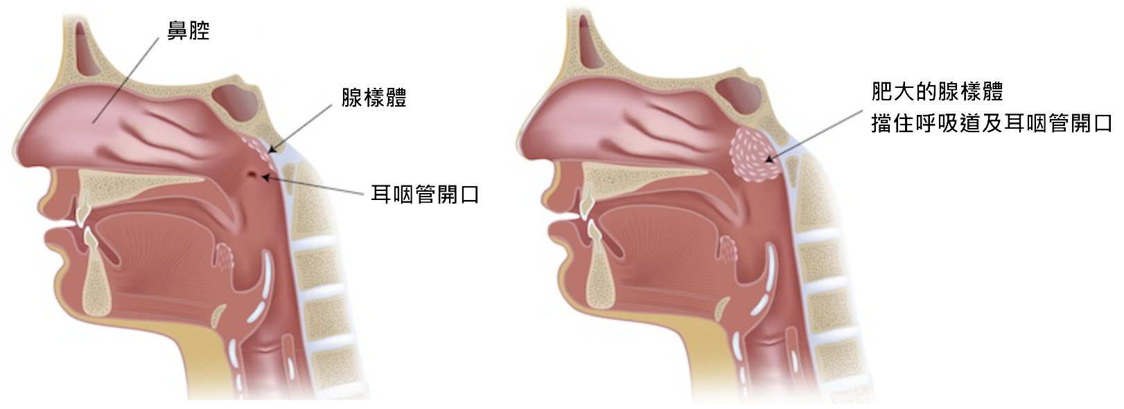 兒童腺樣體肥大與鼻咽部呼吸道堵塞剖面解剖示意圖