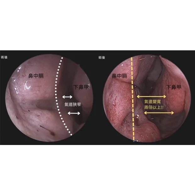 內視鏡鼻中膈矯正手術
