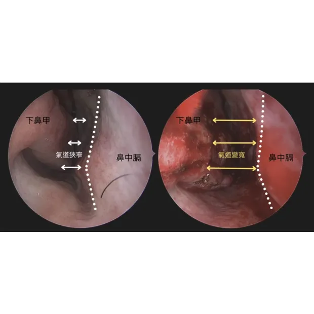 鼻過敏相關手術