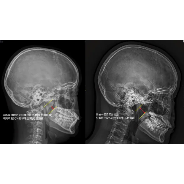 孩子睡覺打呼很大聲，真的是因為「睡得香」嗎？